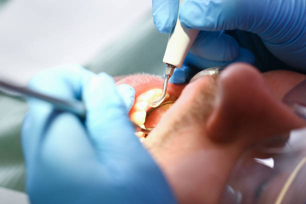 Best Emergency Wisdom Teeth Removal in Mack, OH
